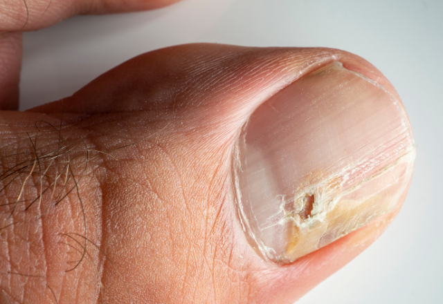 Nagelsvamp Bilder - Exempel på nagelsvamp