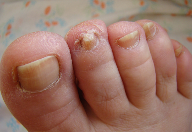 Nagelsvamp Bilder - Exempel på nagelsvamp